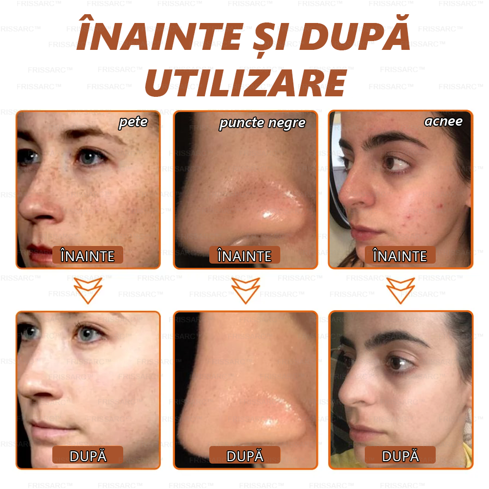 🎁FRISSARC™ masca facială  pentru albire și îndepărtarea petelor –🍀Ingredientele naturale ajută la eliminarea eficientă și de durată a petelor pigmentare, petelor de vârstă, pistruilor și petelor solare.🎁
